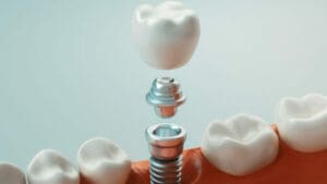Dental implant dentist Mullins SC