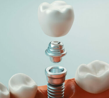 Dental implant dentist Mullins SC