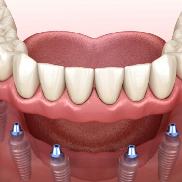 diagram showing implant supported dentures being put on