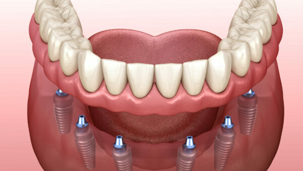 diagram showing implant supported dentures being put on