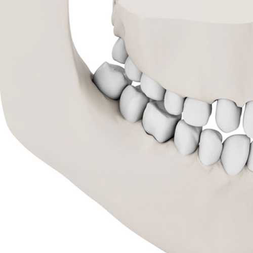 Dental Implant Dentists Mullins Sc