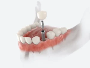 Dental Implants vs. Bridges: Which Is Right for You? in Mullins, SC