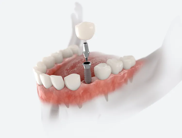 Dental Implants vs. Bridges: Which Is Right for You? in Mullins, SC